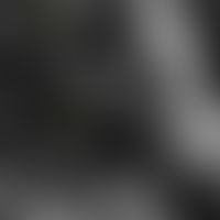 Trichoepitheliom, konventionelles, Laser-Scanning-Mikroskopie: Keratingefüllte Zyste im Tumornest...