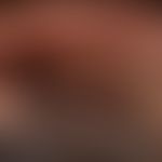Melanom superfiziell spreitendes, Auflichtmikroskopie, Ohrmuschelrand, Tumordicke 1,3 mm, Clark L...