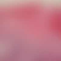 Varizellen: zyotopathischer Effekt mit zahlreichen ballonierten (zytolytischen)&nbsp;Zellen&nbsp;
