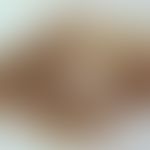 Melanom, Auflichtmikroskopie, unregelmäßig pigmentierter Tumor am linken Oberarm bei 75 jähriger ...