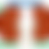 Zystische Nephropathien:&nbsp;Schematische Darstellung einer Zystenniere. Vorlage: Klinikum Dortm...