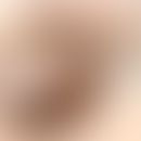 Molluscum contagiosum: diskreter jedoch typischer Befund. Besonders gut ist die klassische Strukt...