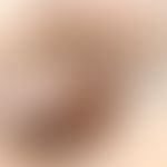 Molluscum contagiosum: diskreter jedoch typischer Befund. Besonders gut ist die klassische Strukt...