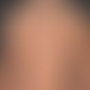 Syphilis (Frühsyphilis):&nbsp;makulöses,&nbsp;chronisches Exanthem. Stellenweise werden auch&nbsp...