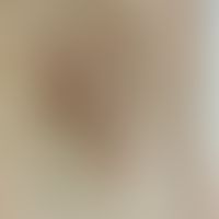 Lichen planus pigmentosus: blande, bräunliche Plaque axillär beidseits. Mundschleimhaut und restl...