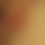 Erythrasma: Mann, 73 Jahre. Zufallsbefund beim Hautkrebsscreening. Die scharf begrenzte ebenmäßig...