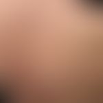 Erythema migrans: Frau, 52 J. seit mehreren Monaten langsam progredientes randscharfes großflächi...