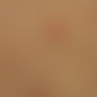 Pityriasis rosea: Frau, 31 Jahre. Herkunftsland Syrien. Vor 2 Wochen Zwillinge entbunden. Das&nbs...