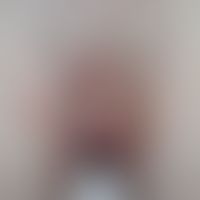 Pityriasis rosea (inverse Variante): irritierte, stark juckende inverse Variante der Pityriasis r...