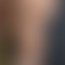 Verruga peruana: länger bestehender warzenförmiger Knoten&nbsp;&nbsp;
