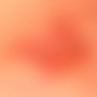 Differenzildiganose: Basalzellkarzinom pigmentiertes

Diagnose:&nbsp; gering pigmentiertes Melano...