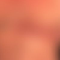 Zoster: Ausbreitung in einem Dermatom (Th5)
