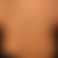Typ I Neurofibromatose, peripherer Typ oder klassische kutane Form. Zahlreiche tiefliegende weich...