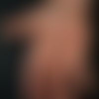 Psoriasis palmaris et plantaris (Plaquetyp):&nbsp; Minusvariante einer plaqueförmigen Psoriasis p...