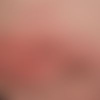 Akute kontaktallergische Dermatitis nach Auftragen einer "Narbensalbe".
