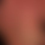 Dermatitis solaris: Verbrennung 1. Grades mit flächenhafter schmerzhafter Rötung.&nbsp;
