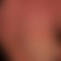 Dermatitis solaris: Verbrennung 1. Grades mit flächenhafter schmerzhafter Rötung.&nbsp;
