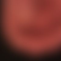 Dermatomyositis: raue rissige Fingerkuppen. Hyperkeratotischer Nagelfalz des Daumens.&nbsp;
