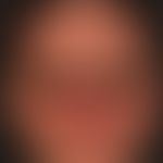 Differenzialdiagnose: Dermatomyositis

Diagnose: entzündlich überlagerte&nbsp;seborrhoische Derma...