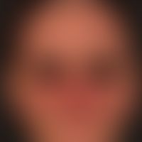Differenzialdiagnose: Dermatomyositis

Diagnose: entzündlich überlagerte&nbsp;seborrhoische Derma...