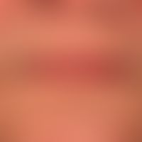 Umweltalterung oder exogene Alterung: hier Lichtalterung. Prominente Follikelstruktur, weißlich g...