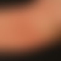 Eccema herpeticatum: plötzliches fieberhaftes Auftreten von disseminierten, genabelten Bläschen. ...