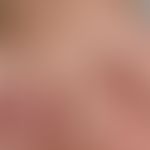 Differenzialdiagnose: Epidermolysis bullosa simpex, Weber-Cockayne

Diagnose:&nbsp;Epidermolysis ...