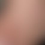 Differenzialdiagnose: Epidermolysis bullosa simpex, Weber-Cockayne

Diagnose:&nbsp;Epidermolysis ...