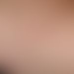 Differenzialdiagnose: Epidermolysis bullosa simpex, Weber-Cockayne

Diagnose:&nbsp;Epidermolysis ...
