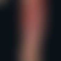 Erysipel, akutes bei Papillomatosis cutis lymphostatica: unter hohem Fieber aufgetretene, scharf ...