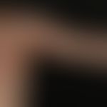 Naevus verrucosus unius lateralis: Epidermales Hamartom in typischer streifenförmiger Anordnung. ...