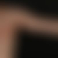 Naevus verrucosus unius lateralis: Epidermales Hamartom in typischer streifenförmiger Anordnung. ...
