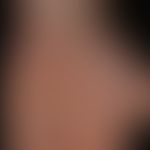 Naevus verrucosus: streifenförmige und flächige Ausprägung des epidermalen Hamartoms.&nbsp;
