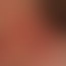 Interstitielle granulomatöse Dermatitis mit Arthritis: rezidivierende unscharf begrenzte erythema...