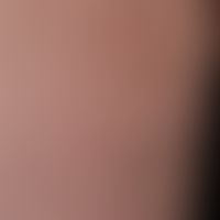 Erythema e calore: durch häufigen Gebrauch eines Heizkissens hervorgerufenes, netzförmiges, persi...