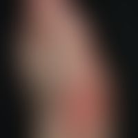 Arthritis urica:&nbsp;residualer Hallux valgus. Nebenbefundlich: Onychomykose der Großzehe.

&nbsp;

