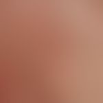 Erythema anulare centrifugum: multiple,&nbsp;zentrifugal wachsende, rote, randständig raue, schup...