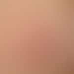 Erythema anulare centrifugum: Einzelläsion mit peripher fortschreitenden Plaque, die zentral abfl...