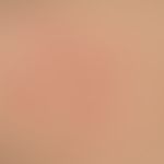 Erythema anulare centrifugum: Einzelläsionen&nbsp;mit peripher fortschreitenden Plaques, die eina...