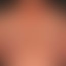 Erythema anulare centrifugum bei Rheumatoider Arthritis:&nbsp;multiple, chronisch aktive, zentrif...
