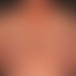 Erythema anulare centrifugum bei Rheumatoider Arthritis:&nbsp;multiple, chronisch aktive, zentrif...