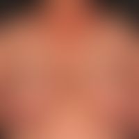 Erythema anulare centrifugum bei Rheumatoider Arthritis:&nbsp;multiple, chronisch aktive, zentrif...