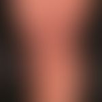 Differenzialdiagnose: Erythema anulare centrifugum

Diagnose: Sarkoidose der Haut
