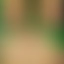 Akutes Syndrom der apoptotischen Pan-Epidermolyse: Akutes solar-akzentuiertes Krankheitsbild mit ...