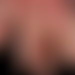 Paraproteinämie&nbsp;und Hautveränderungen: Livedo-artige purpurische Erytheme sowie krustige Nek...