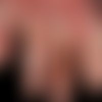 Paraproteinämie&nbsp;und Hautveränderungen: Livedo-artige purpurische Erytheme sowie krustige Nek...