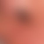 Paraproteinämie&nbsp;und Hautveränderungen: vaskulitische (wie ausgestanzt wirkende) Nekrose bei ...