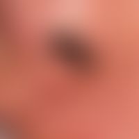 Paraproteinämie&nbsp;und Hautveränderungen: vaskulitische (wie ausgestanzt wirkende) Nekrose bei ...