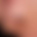 Paraproteinämie&nbsp;und Hautveränderungen: vaskulitische (wie ausgestanzt wirkende) Nekrose bei ...