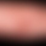 Paraproteinämie&nbsp;und Hautveränderungen: vaskulitische Nekrose bei bekanntem Myelom.&nbsp;

